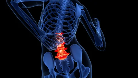 Human Suffering with Severe Back Pain in Lumbar Vertebrae Anatomy 動画素材 340011564