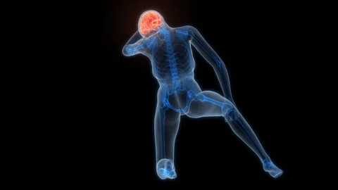 Human Suffering with Severe Headache Anatomy Animation Concept Stock Footage 307403233