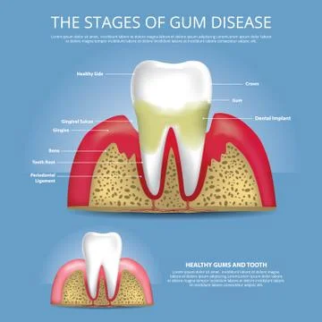 Human teeth Gum Disease Vector Illustration Illustrazione stock