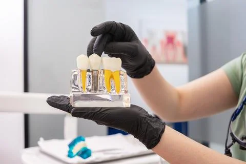 Human teeth model, pointing crown of dental implant, offering advice on dental Stock Photos