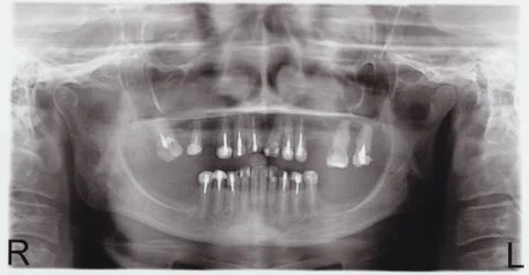 Human teeth Foto stock