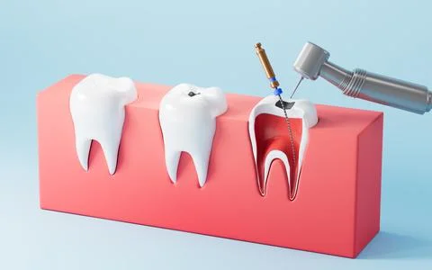Human teeth root canal treatment process. 3d rendering. 스톡 일러스트