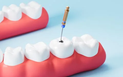 Human teeth root canal treatment process. 3d rendering. 스톡 일러스트
