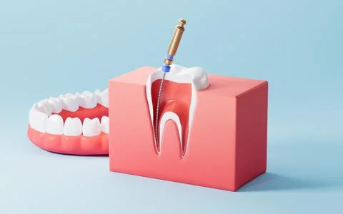 Human teeth root canal treatment process. 3d rendering. 스톡 일러스트