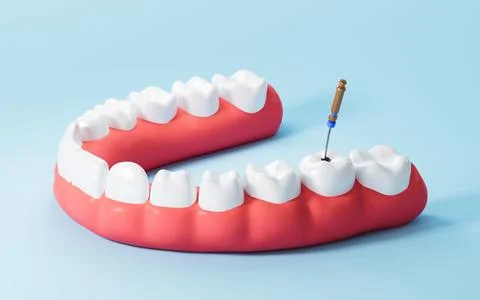 Human teeth root canal treatment process. 3d rendering. 스톡 일러스트