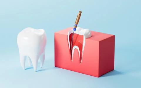Human teeth root canal treatment process. 3d rendering. 스톡 일러스트