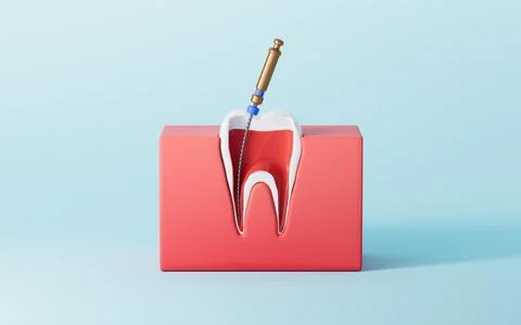 Human teeth root canal treatment process. 3d rendering. 스톡 일러스트