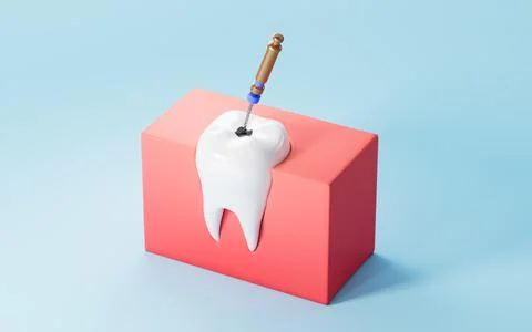 Human teeth root canal treatment process. 3d rendering. 스톡 일러스트