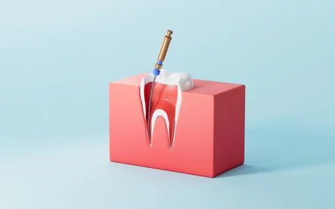 Human teeth root canal treatment process. 3d rendering. 스톡 일러스트