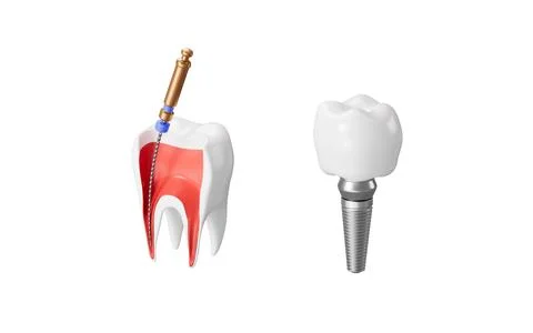 Human teeth root canal treatment process and implant teeth. 3d rendering. 스톡 일러스트