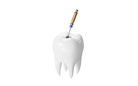 Human teeth root canal treatment process. 3d rendering. 스톡 일러스트