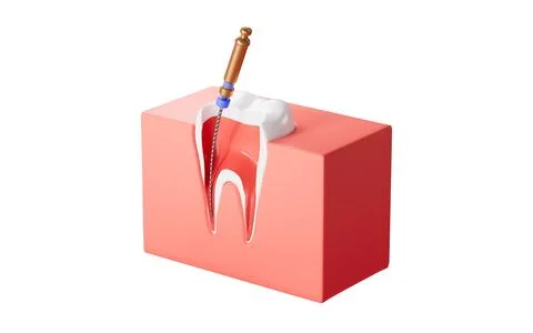Human teeth root canal treatment process. 3d rendering. 스톡 일러스트