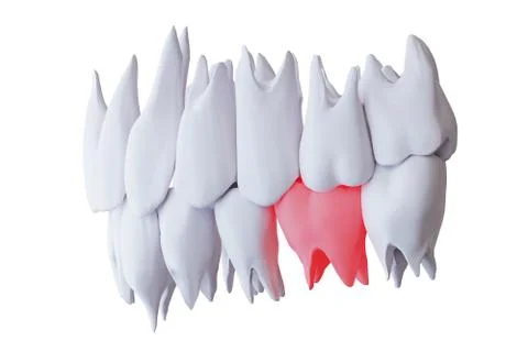 Human teeth with a sore tooth, red lower sixth molar tooth, isolated on white Stock Illustration