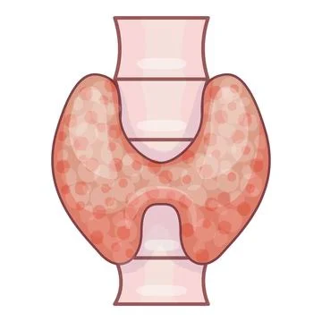 Human thyroid gland suffering from autoimmune disease illustration Stock Illustration
