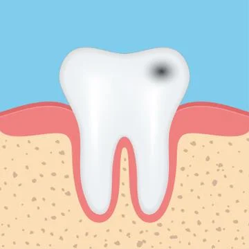 Human tooth with caries Stock Illustration