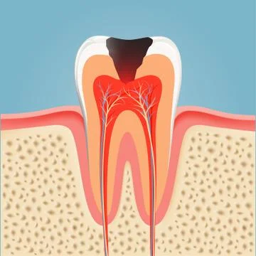 Human tooth with caries. Stock vector Stock Illustration