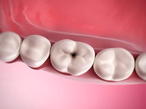 Human tooth decay, illustration Illustrazione stock