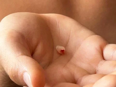 Human Tooth Fragment Held in Hand, Dental Care and Oral Health Concept Stock Photos