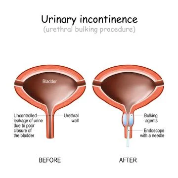 Human urinary bladder, and Urethral bulking procedure with endoscope Illustration