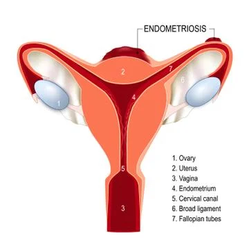 Human Uterus with Endometriosis Stock Illustration