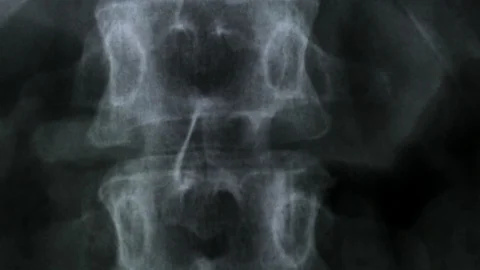  Human vertebral column  X-ray  Stock Footage 126411316