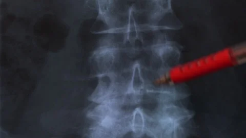 Human vertebral column X-ray  Stock Footage 126416528
