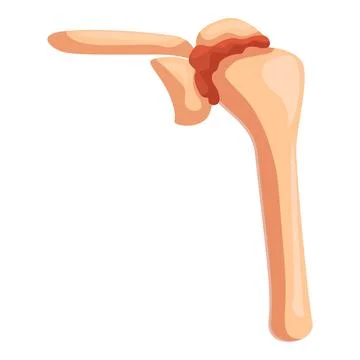 Humerus bone showing glenohumeral joint inflammation 库存插图