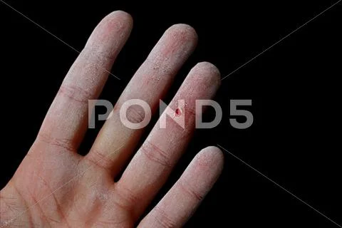 Hurt hand Stock Photos