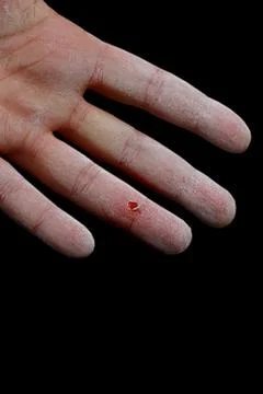 Hurt hand Stock Photos