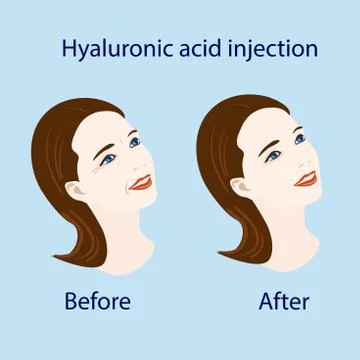 Hyaluronic acid injection, before and affect , vector illustration Stock Illustration