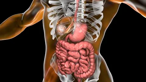 Hydatid cyst of Echinococcus granulosus in the liver Stock Illustration