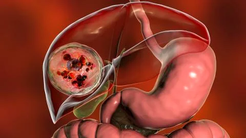 Hydatid cyst of Echinococcus granulosus in the liver Stock Illustration