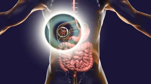 Hydatid cyst of Echinococcus granulosus in the liver Illustrazione stock