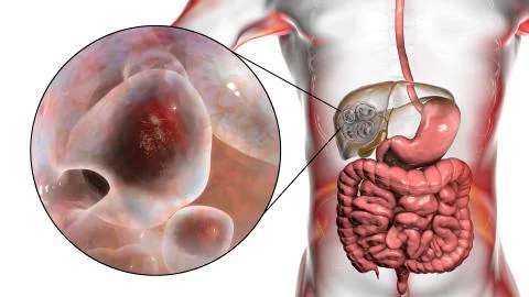 Hydatid cyst of Echinococcus multilocularis イラスト素材