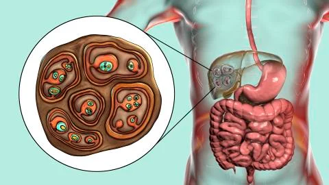 Hydatid cyst of Echinococcus multilocularis Stock Illustration