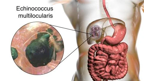 Hydatid cyst of Echinococcus multilocularis イラスト素材