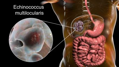 Hydatid cyst of Echinococcus multilocularis イラスト素材