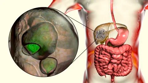 Hydatid cyst of Echinococcus multilocularis イラスト素材