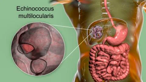 Hydatid cyst of Echinococcus multilocularis イラスト素材