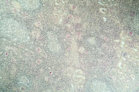 Hydronephrose Stock Photos