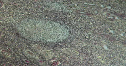 Hydronephrosis diseased tissue Stock Footage 139345259