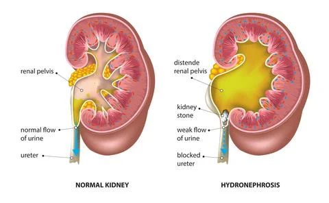 Hydronephrosis Kidney Illustrazione stock