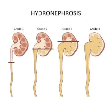 Hydronephrosis stage. Stock Illustration