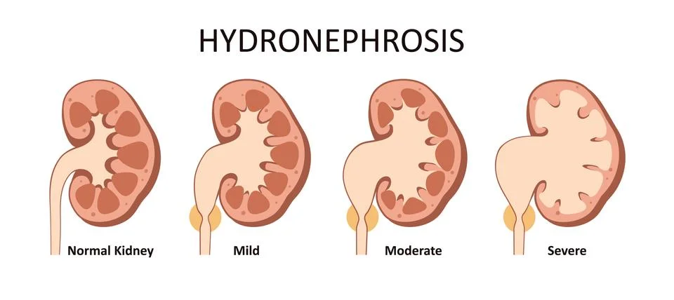 Hydronephrosis stage. Vector illustration Stock Illustration