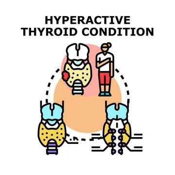Hyperactive thyroid gland condition impacting human health concept Stockillustratie