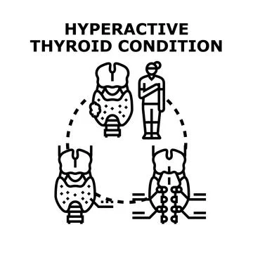 Hyperactive thyroid gland condition impacting human health concept Stock Illustration