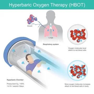 Hyperbaric Oxygen Therapy Stock Illustration