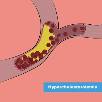 Hypercholesterolemia. Stock Illustration