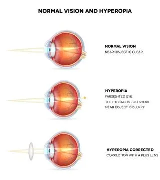 Hyperopia and normal vision Stock Illustration