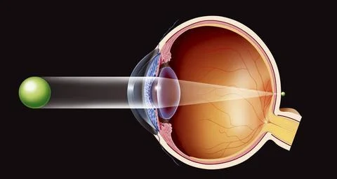  Hyperopia drawing Illustration of a farsighted (hypermetropic) eye (eyeba... Stock Photos